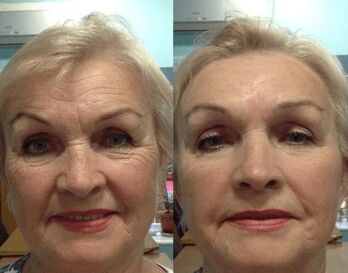 Goji Cream anti-wrinkle cream use experience - personal photo before and after