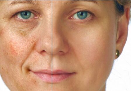 The result of the rejuvenation