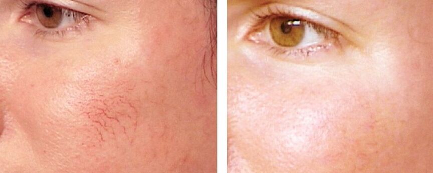 Rosacea withdrawal