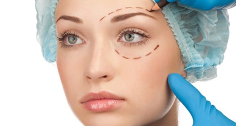 Surgical facelift
