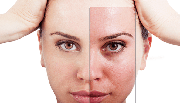 fractional rejuvenation eliminates the main aesthetic defects of the face